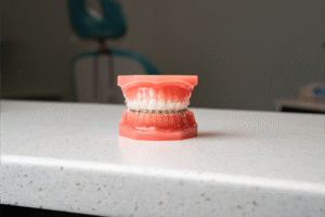 Model of teeth with clear braces on a countertop in BZ Orthodontics office, showcasing orthodontic services in Lansdale, PA.